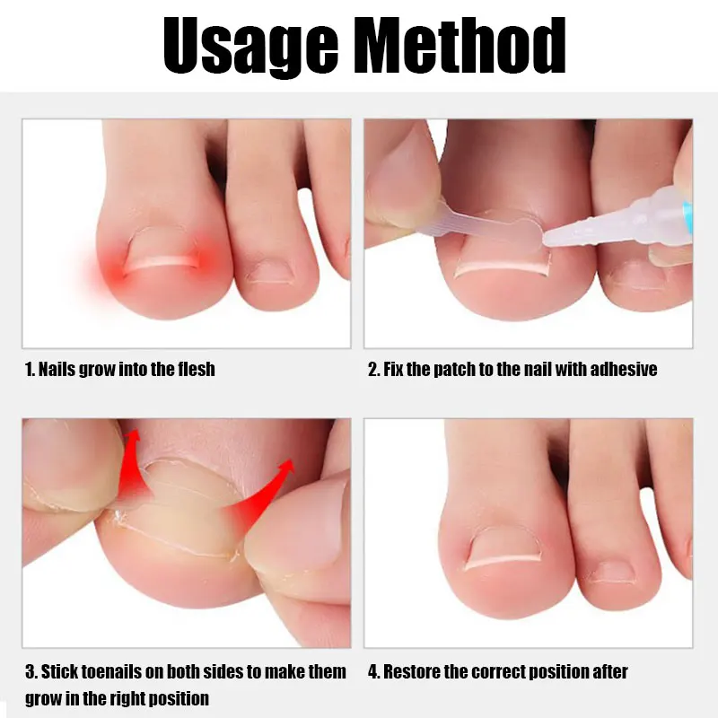 10pc/box Ingrown Toenail Correction Tool Straightening Clip Brace Ingrown Toe Nail Treatment Elastic Patch Sticker Pedicure Tool