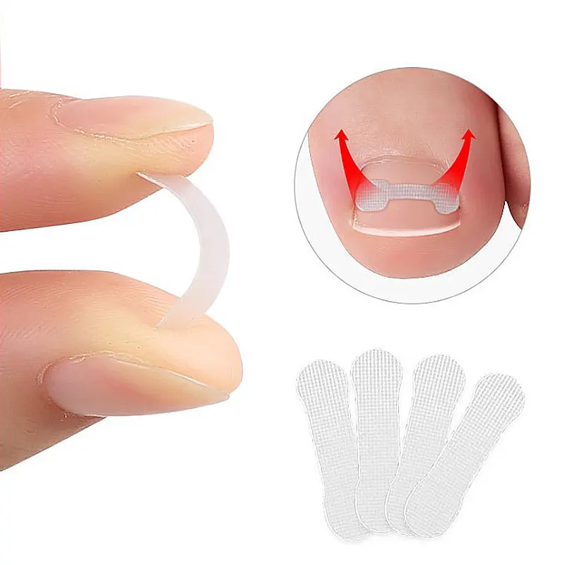10pc/box Ingrown Toenail Correction Tool Straightening Clip Brace Ingrown Toe Nail Treatment Elastic Patch Sticker Pedicure Tool