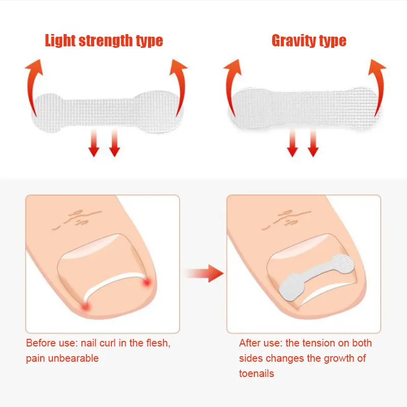 10pc/box Ingrown Toenail Correction Tool Straightening Clip Brace Ingrown Toe Nail Treatment Elastic Patch Sticker Pedicure Tool
