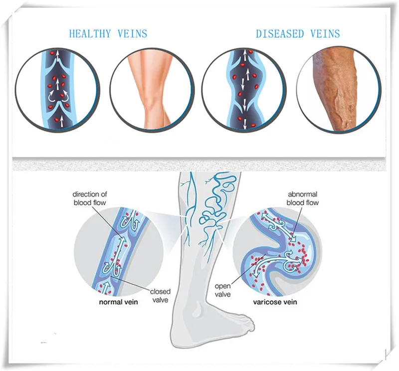 Grade Compression Stockings Women Men For Varicose Spider Edema 30-40 MMHg Support Gradient S-4XL Travel Pressure Legs