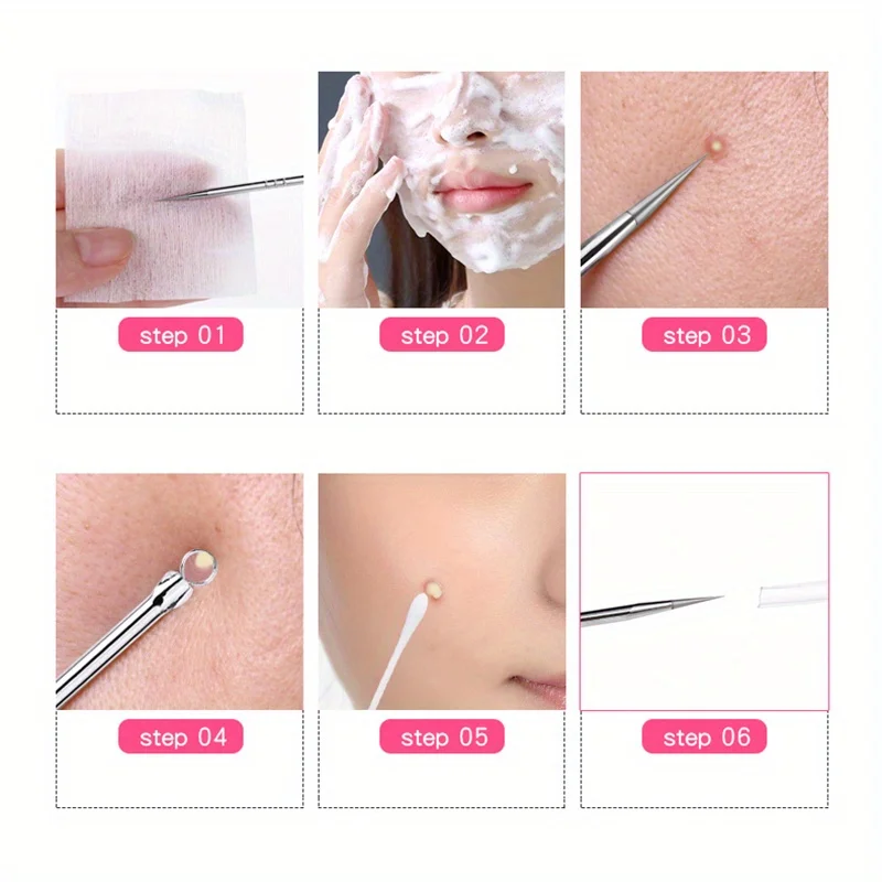 Stainless Steel Blackhead Remover, Pimple Popper Tool for Blemish, Whitehead, Acne Removal, Suitable for Normal Skin