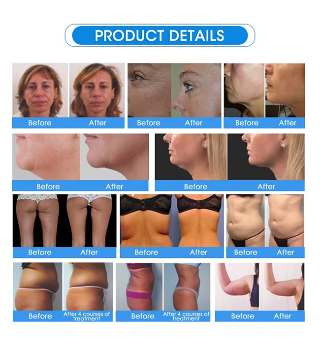 2026 Newest SLyric Fat Burner Fat Remover Face Lifting Skin Tightening Slimming Body Contouring Cellulite Professional