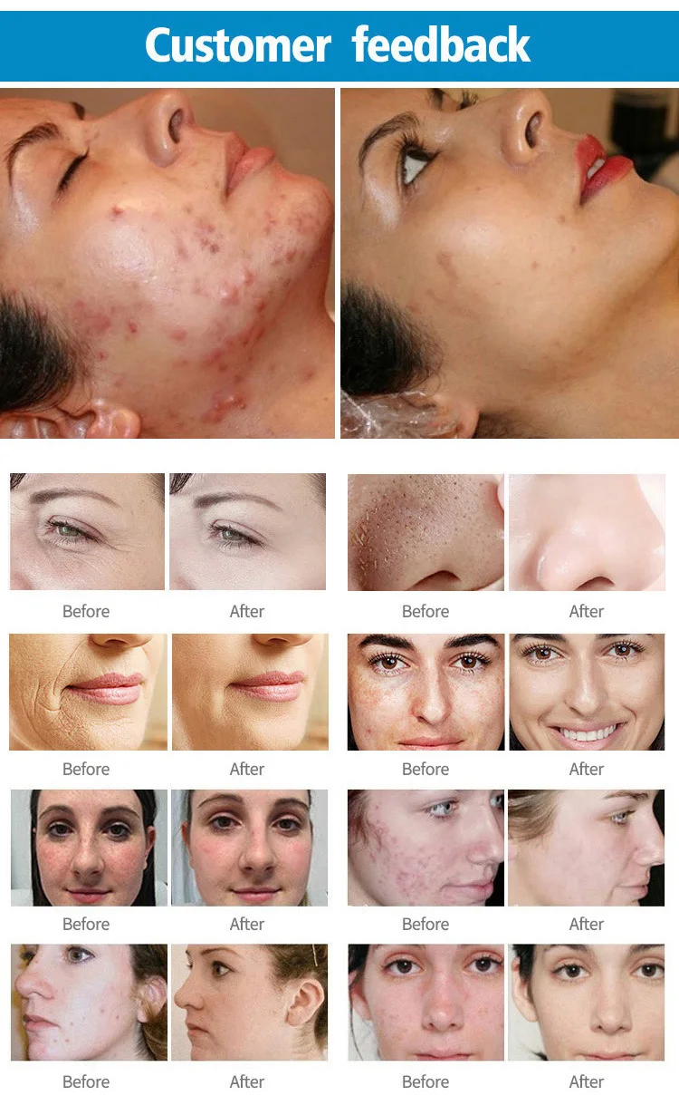 80W Fractional CO2 Laser Machine 10600nm Professional CO2 Laser Beauty Machine for Scar Removal Skin Tightening Acne Treatment
