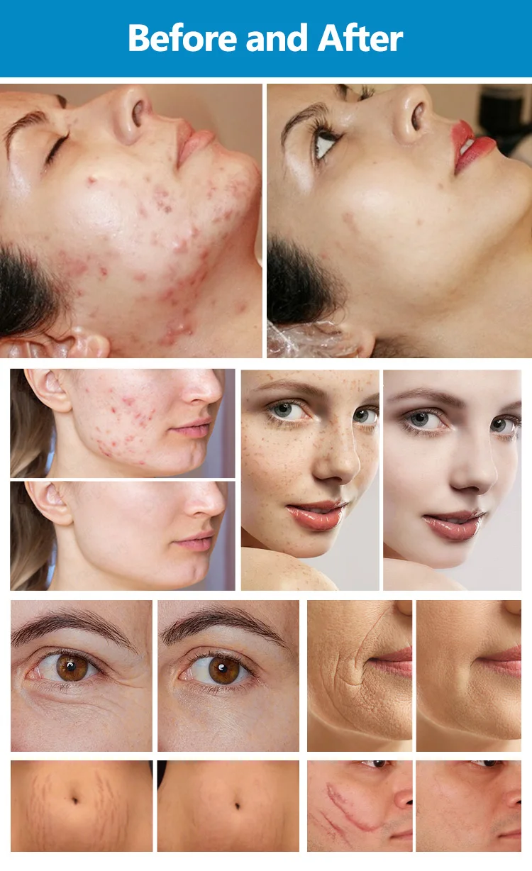 2026 Fractional CO2 Laser Machine 10600nm Professional CO2 Laser Beauty Machine for Scar Removal Skin Tightening Acne Treatment