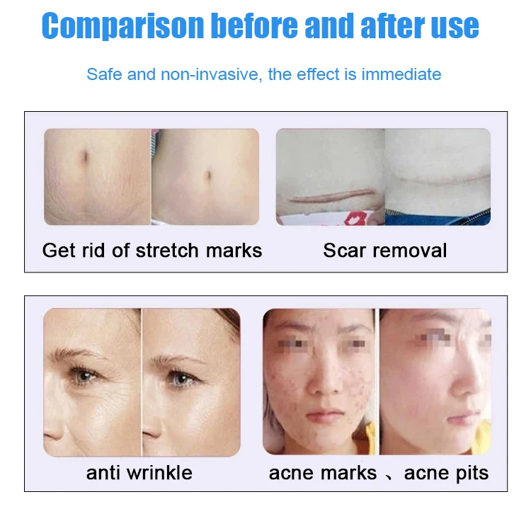 2026 Fractional CO2 Laser Machine 10600nm Professional CO2 Laser Beauty Machine for Scar Removal Skin Tightening Acne Treatment