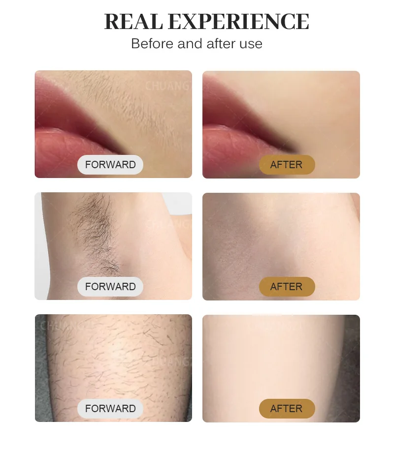 Newest Diode YAG Hair Removal Device - Triple Wavelength 2000W Power Painless and Permanent 755nm 808nm 1064nm
