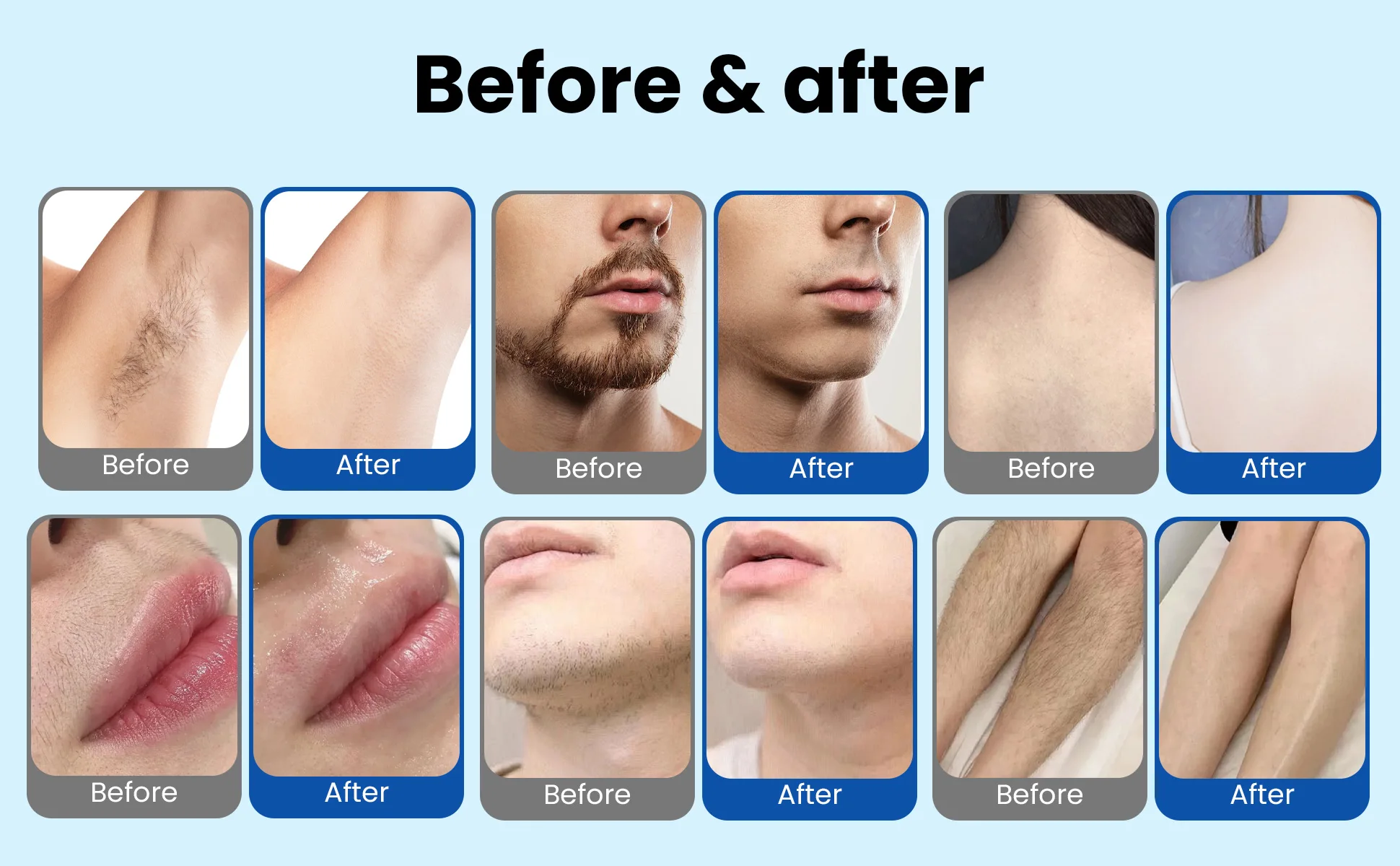 Diode Laser Hair Removal Device810 5000W 16Bars Upgraded Version Painless Permanent Hair Removal Three Wavelength Cooling System