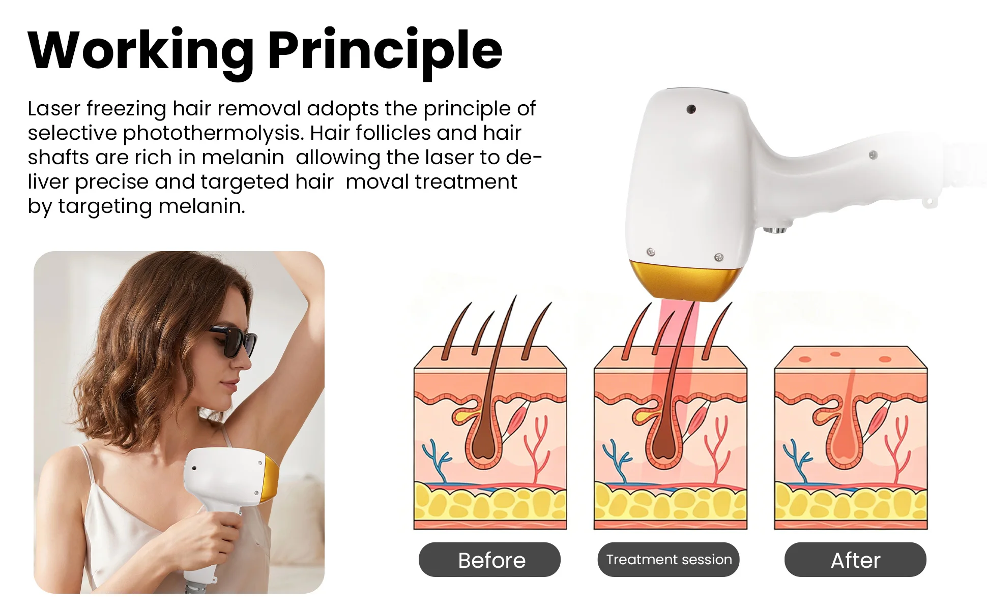 Diode Laser Hair Removal Device810 5000W 16Bars Upgraded Version Painless Permanent Hair Removal Three Wavelength Cooling System