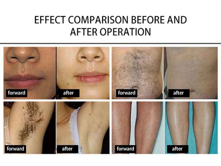 4000W Titanium Diode Laser Epilator Permanent Hair Removal Professional Laser 3 Wavelength 755 808 1064nm Painless Hair Removal
