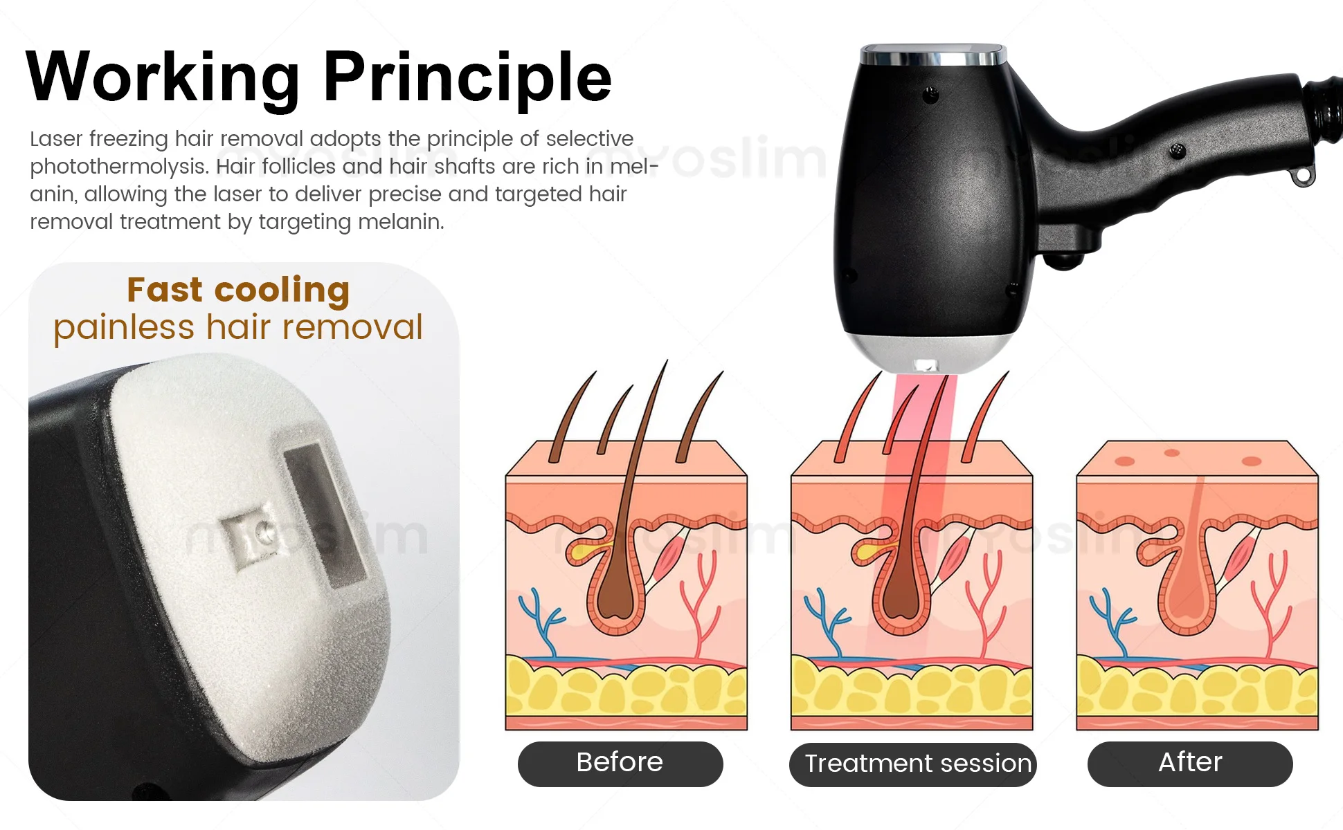 Diode Ice Titanium Lase 5000w FAC 4 Waves 808nm 755/808/940/1064NM Portable Device Soprano Body Hair Removal