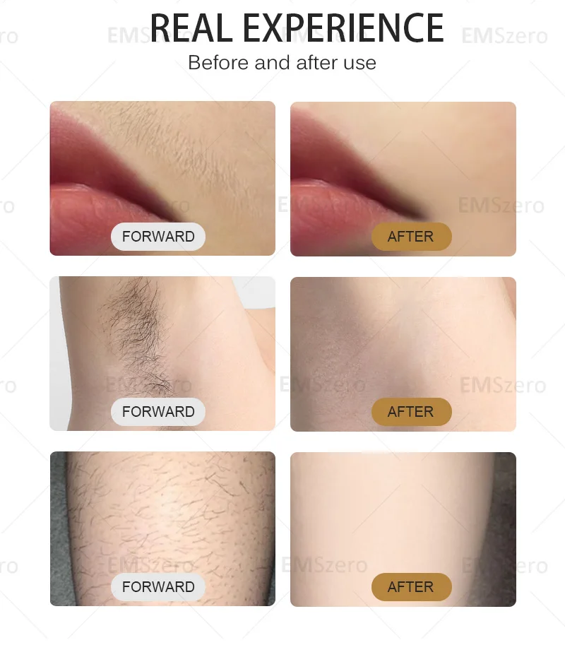 808 Diode Laser Hair Removal Machine 755 808 1064nm Wavelengths Cooling Head Painless Laser Epilator Face Body Hair Removal