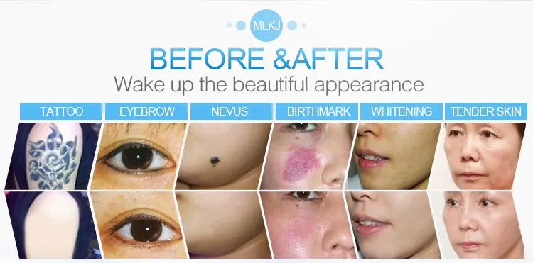 M22 IPL OPT Machine Aesthetic Laser Hair Remove E-Light Skin Rejuvenation Machine Vascular MultiApplication Hair Removal
