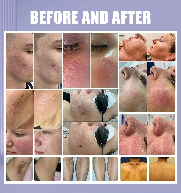 M22 IPL OPT Machine Aesthetic Laser Hair Remove E-Light Skin Rejuvenation Machine Vascular MultiApplication Hair Removal