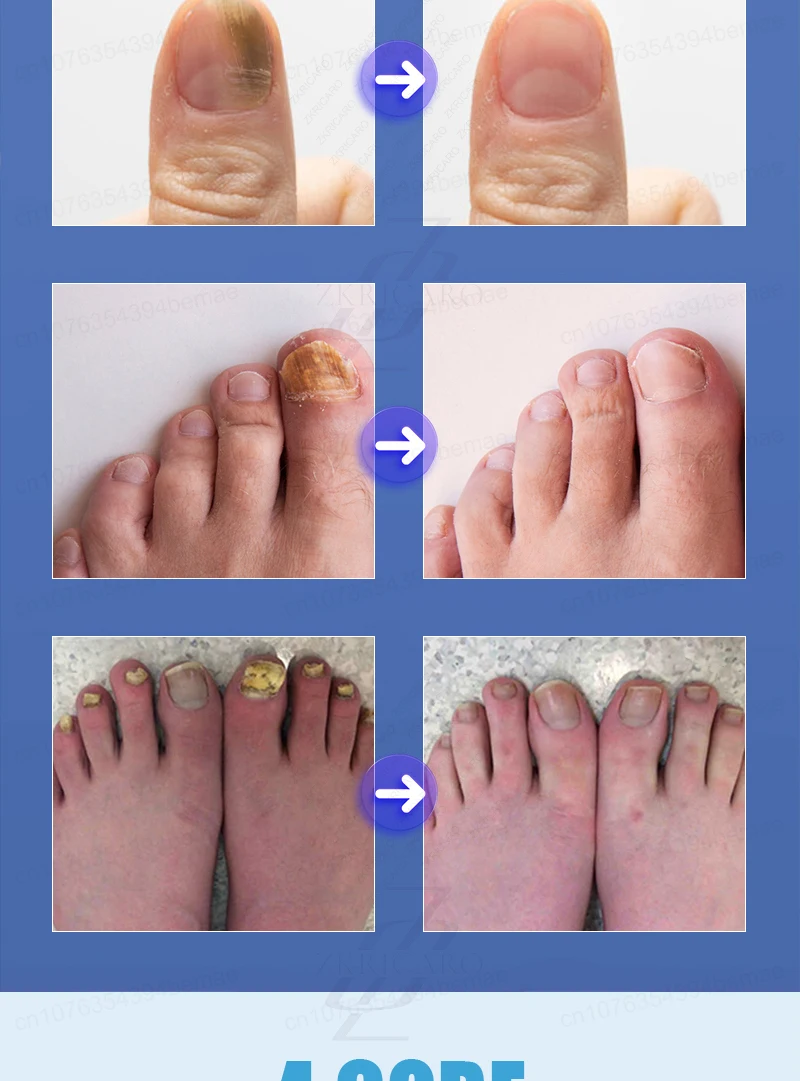 Advanced Laser Pen for Healthy Nail Growth
