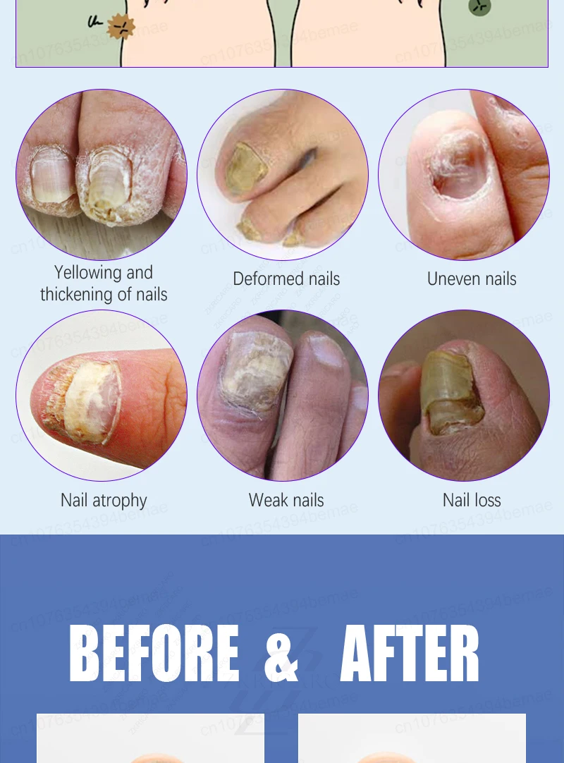 Advanced Laser Pen for Healthy Nail Growth