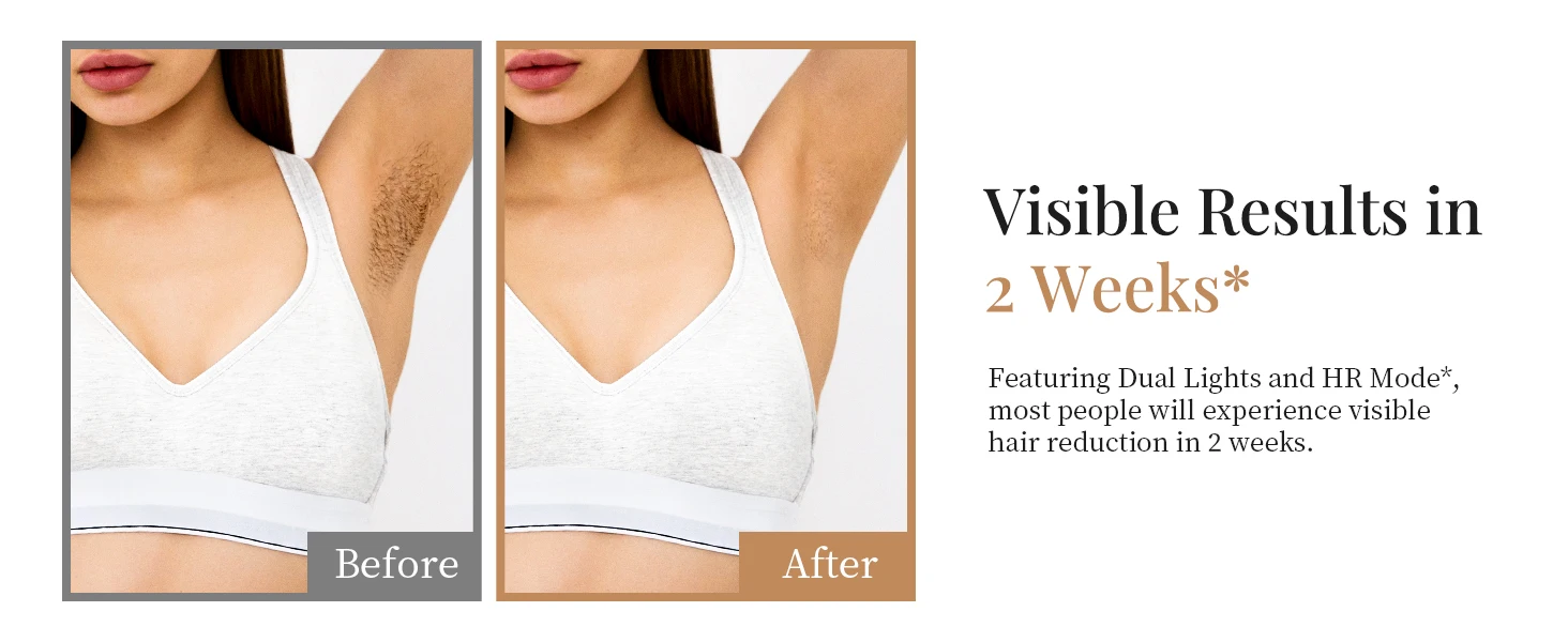 IPL Hair Removal 999900+ Fast Flashes 9 Energy Levels 22j Painless Epilator Face Armpits Legs Binikis Body Hair Trimmer