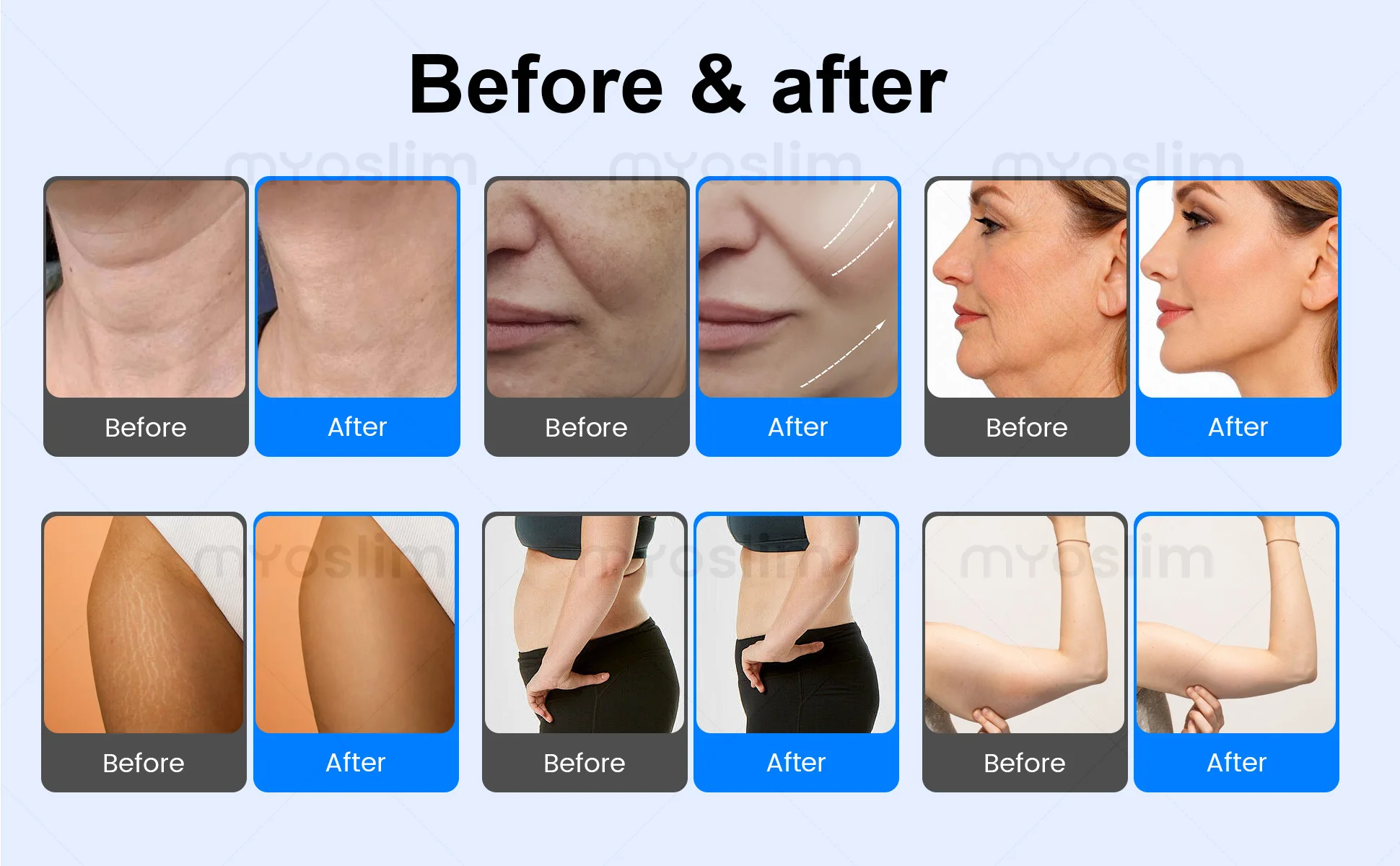The Most Popular 448KHZ Tecar Therapy Machine Slimming Pain Relief SPA Beauty Skin Rejuvenation Diathermy Equipment