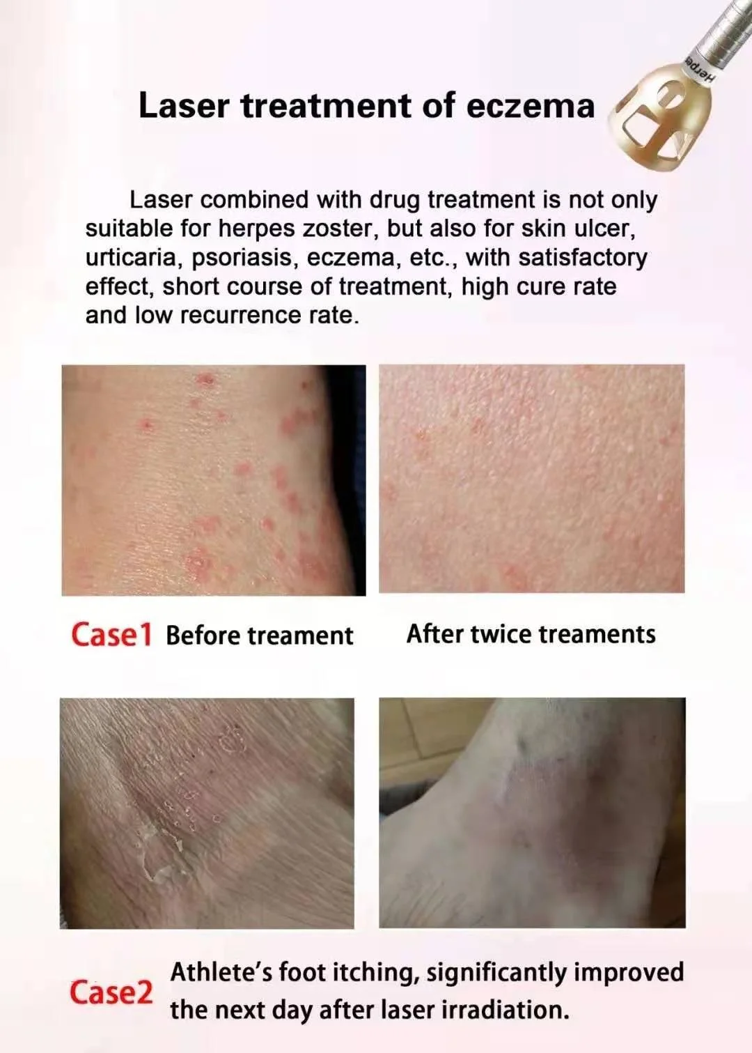 BEST 5 in 1 980nm Diode Laser Vascular Removal Machine Remove Spider Veins 980 Diode Laser Blood Vessels Removal Nail Fungus