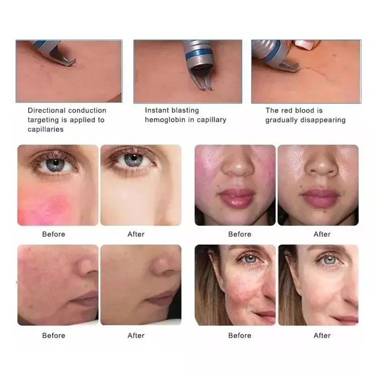 BEST 5 in 1 980nm Diode Laser Vascular Removal Machine Remove Spider Veins 980 Diode Laser Blood Vessels Removal Nail Fungus