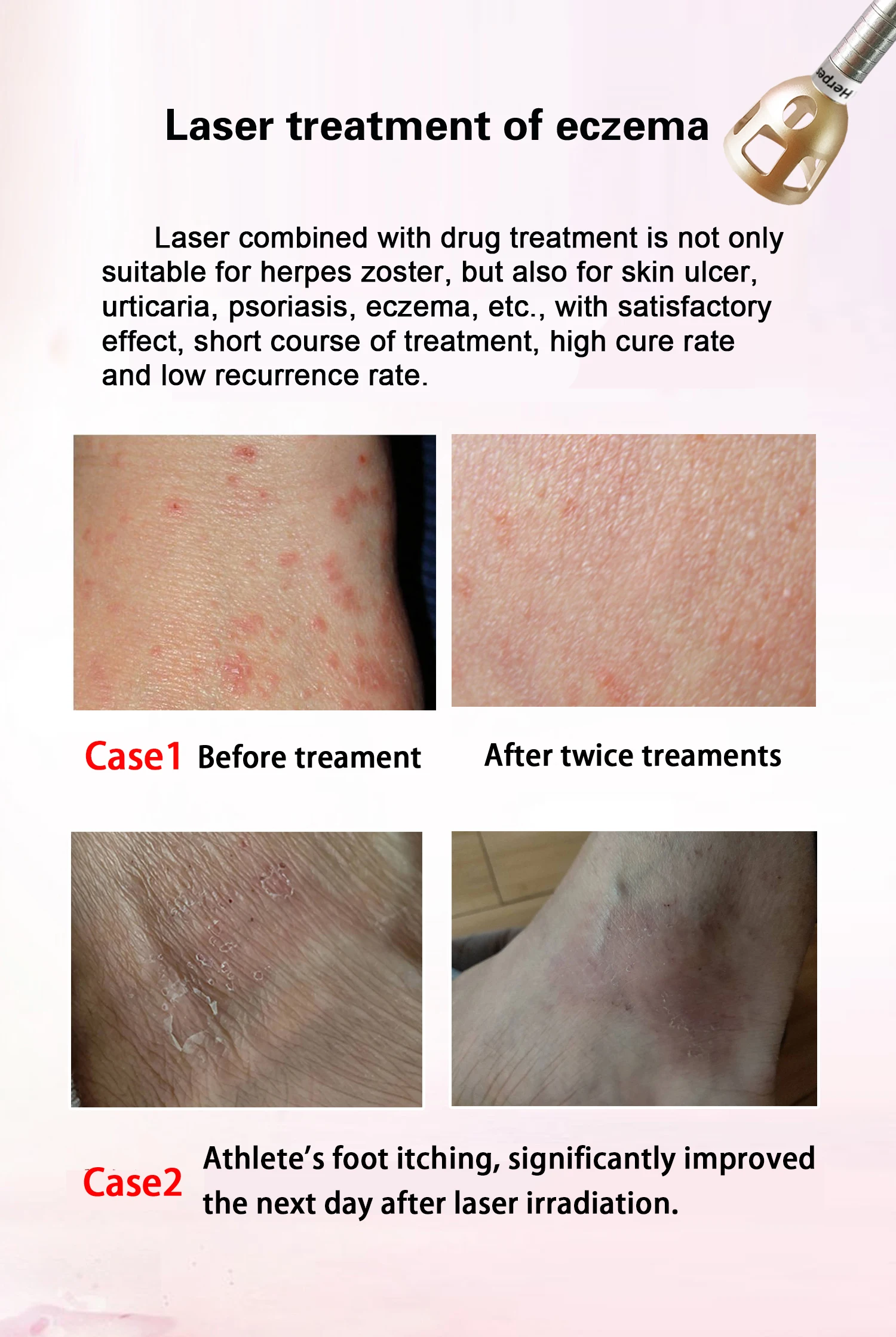 BEST 5 in 1 980nm Diode Laser Vascular Removal Machine Remove Spider Veins 980 Diode Laser Blood Vessels Removal Nail Fungus