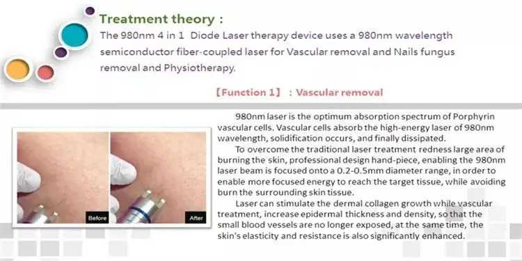 BEST 5 in 1 980nm Diode Laser Vascular Removal Machine Remove Spider Veins 980 Diode Laser Blood Vessels Removal Nail Fungus