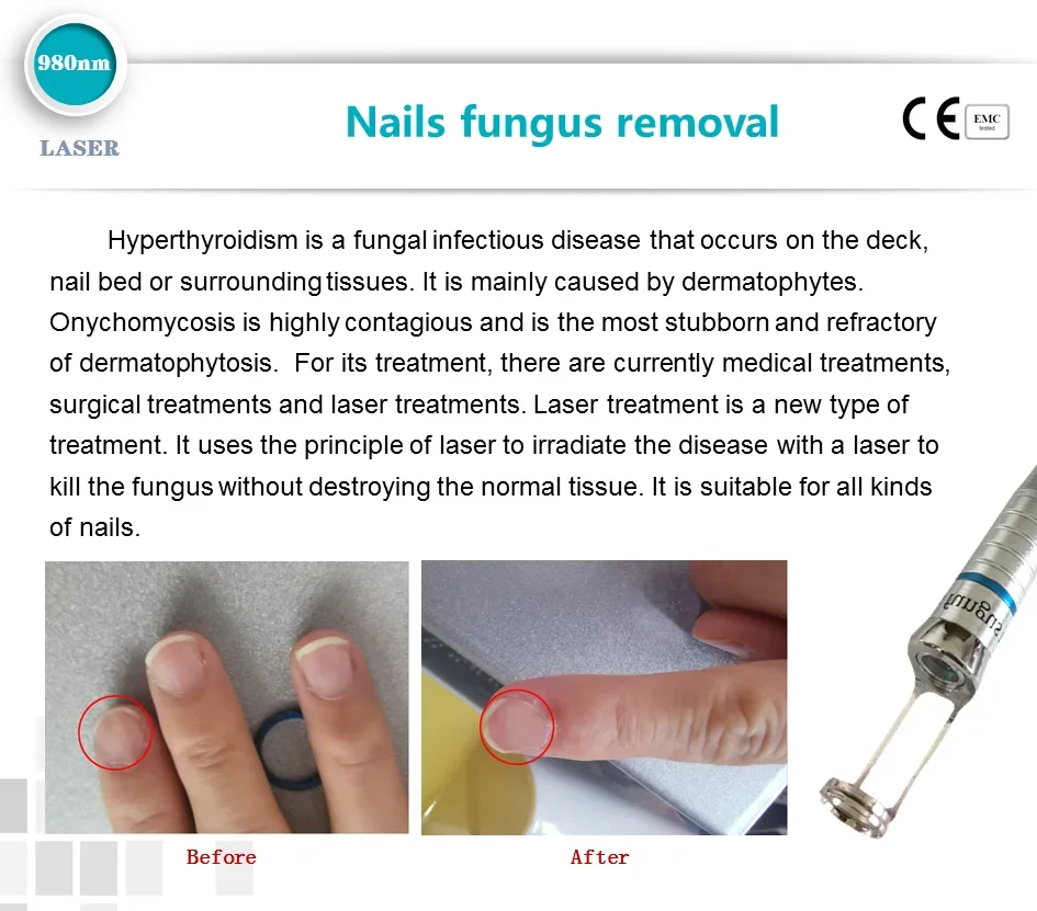 BEST 5 in 1 980nm Diode Laser Vascular Removal Machine Remove Spider Veins 980 Diode Laser Blood Vessels Removal Nail Fungus
