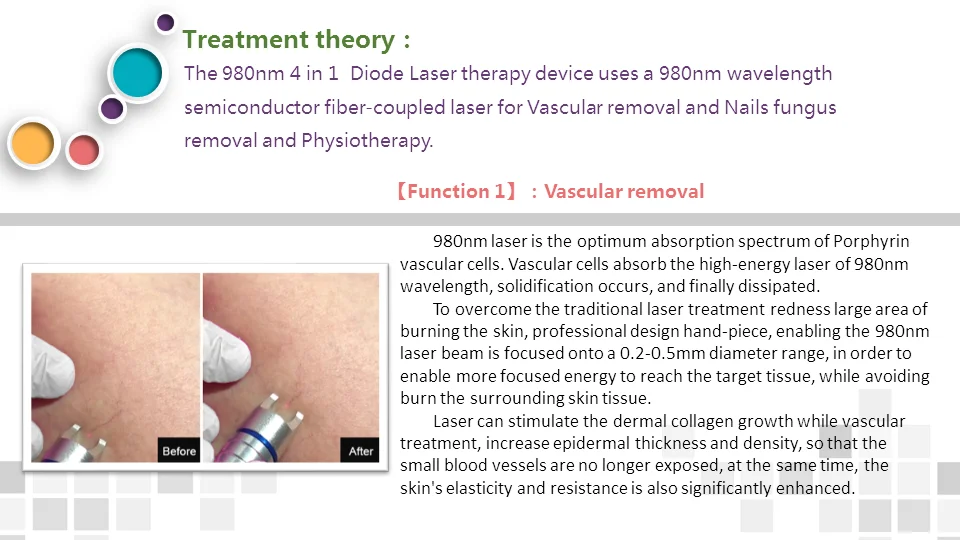 BEST 5 in 1 980nm Diode Laser Vascular Removal Machine Remove Spider Veins 980 Diode Laser Blood Vessels Removal Nail Fungus