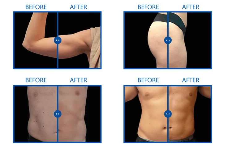 EMS Body Slimming Machine Electrical Muscle Stimulation for Sculpting Fat Burning Weight Control Carving Fitness Equipment