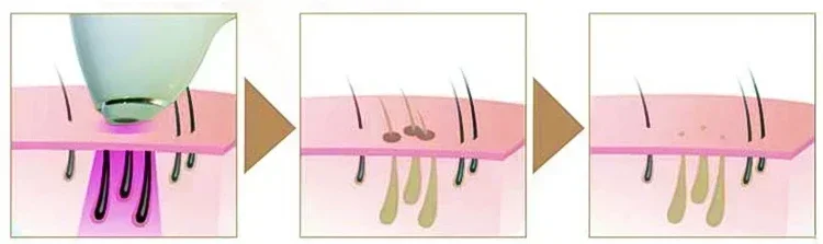 Professional 808nm Diode Laser 3000w High Power 755 808 1064nm Laser Painless Freezing Point Eepilation for Women
