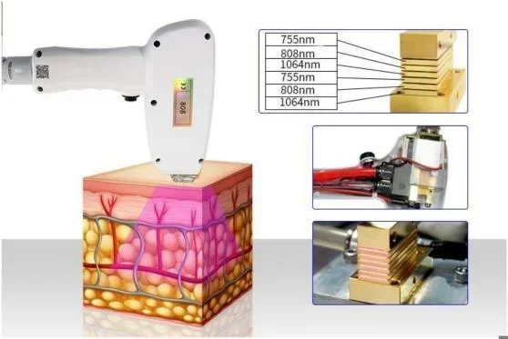 Professional 808nm Diode Laser 3000w High Power 755 808 1064nm Laser Painless Freezing Point Eepilation for Women