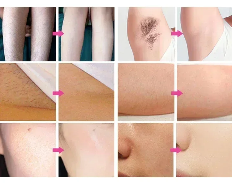 Professional 808nm Diode Laser 3000w High Power 755 808 1064nm Laser Painless Freezing Point Eepilation for Women