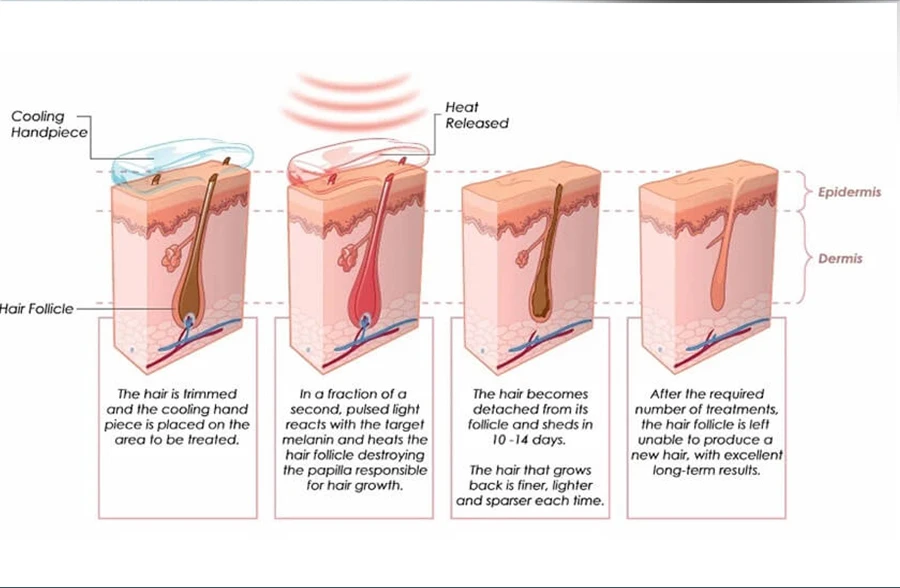 3 In 1 Soprano Professional Laser Machine 4000W IPL OPT 480NM 530NM 640NM Nd:Yag RF Hair Removal & Tattoo Cleaning New Model