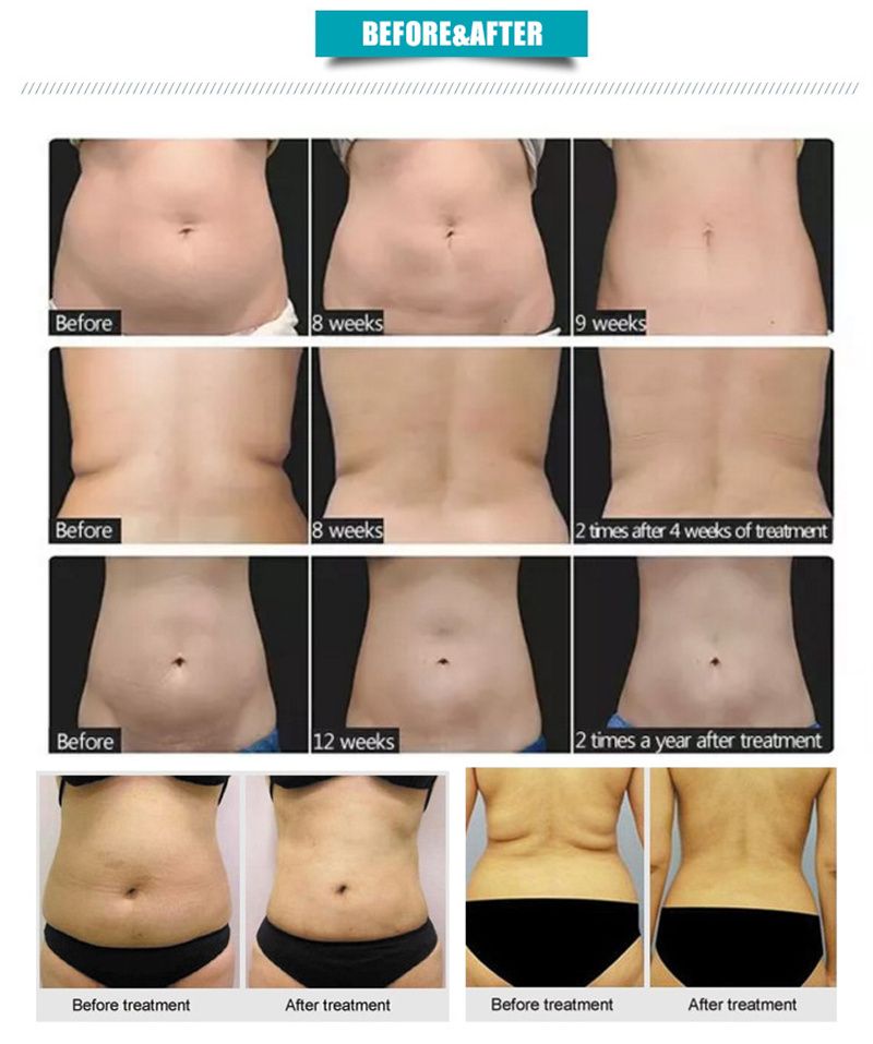 Portable NEO Equipment Slimming Machine Ultrasonic Cellulite Wrinkle Removal Face Lift 2 Handles Ultra 360 Fat Reducing Machine