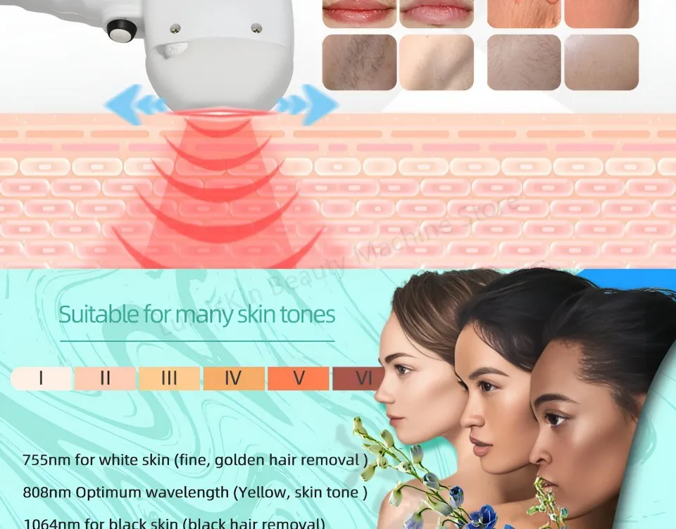 5 Wavelength Diode Laser Hair Removal Machine 755nm 808nm 830nm 940nm 1064nm Ice Point Painless FAC Technology 5000W High Power