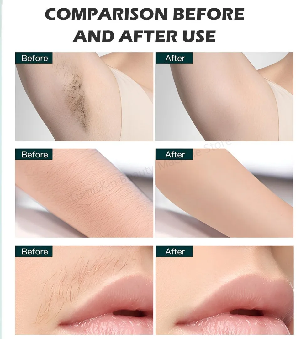 5 Wavelength Diode Laser Hair Removal Machine 755nm 808nm 830nm 940nm 1064nm Ice Point Painless FAC Technology 5000W High Power