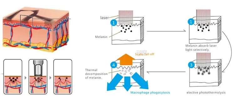 2-In-1 Soprano Diode Picosecond Lase Machine Permanent Ice-Point Hair Removal 755 808 1064nm 4 Wavelengths CE