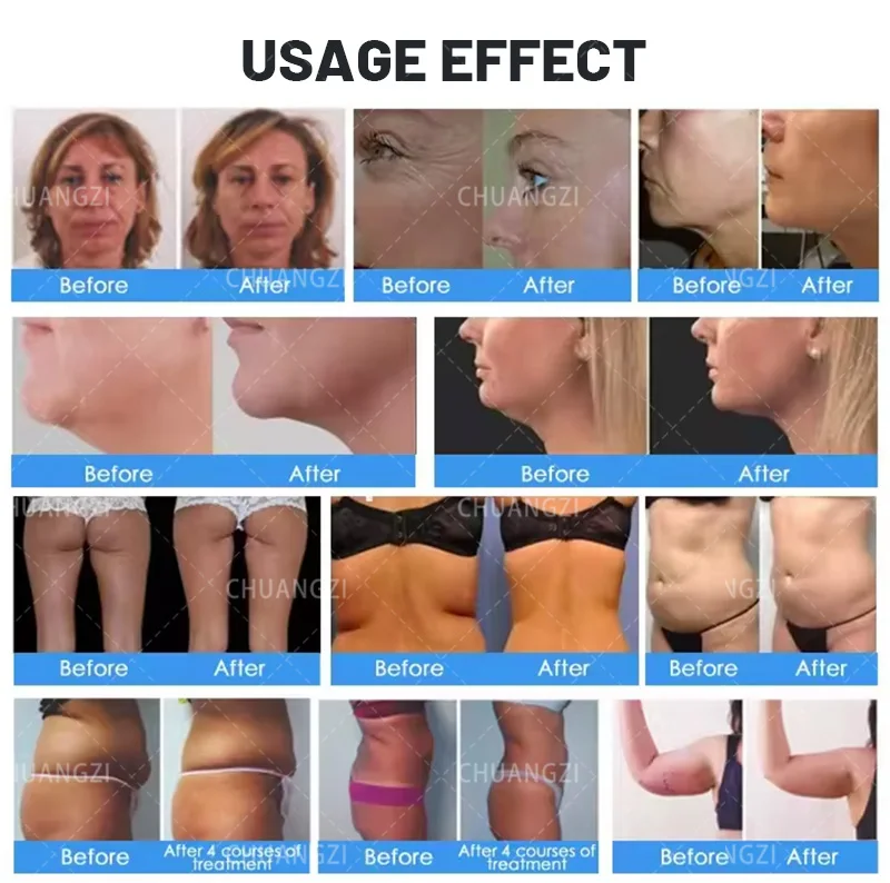 360 Fat Slimming Machine 2 in 1 Monopolar Radiofrequency Facial Rejuvenation and Firming Super Wrinkle Removal Face Lift