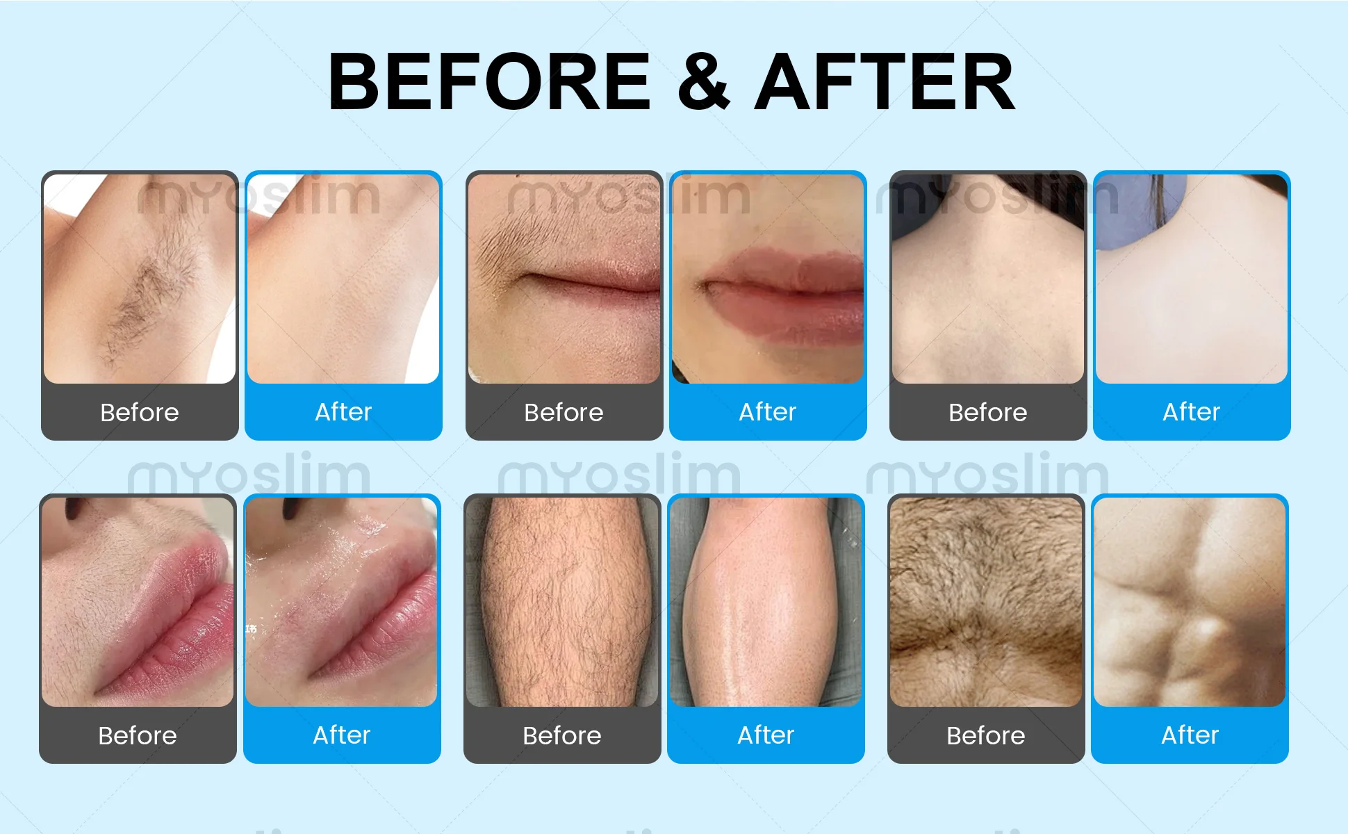 808 Diode Hair Removal Lase Machine FAC 5000W 4 Wavelength Permanent Painless Skin Rejuvenation Firming Body Alexandrit Epilator