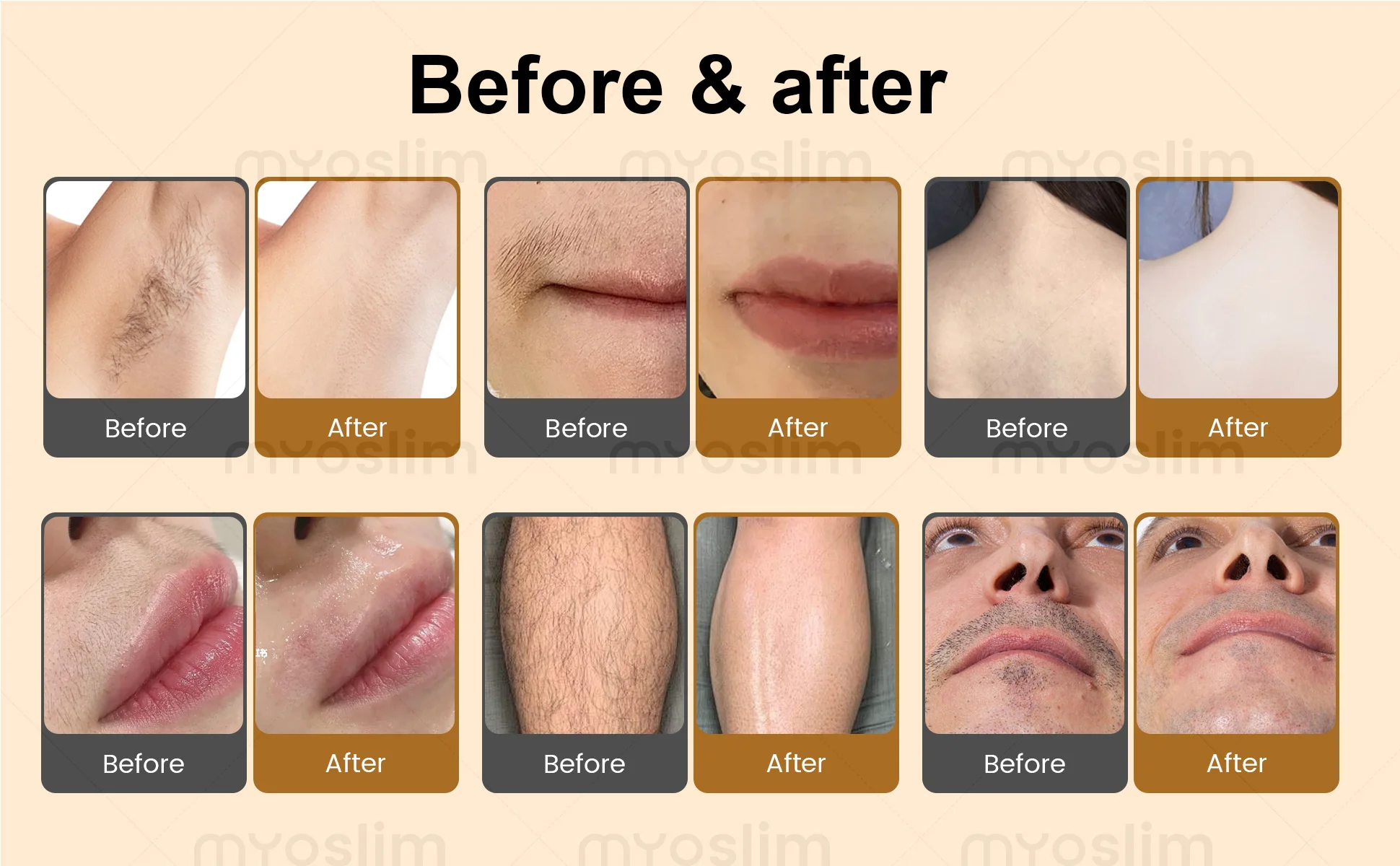 Professional 5000W Ice Titanium Lase Body Hair Removal Machine 3 Wavelength 755/808/1064nm Face Hair Remove For Salon Epilator