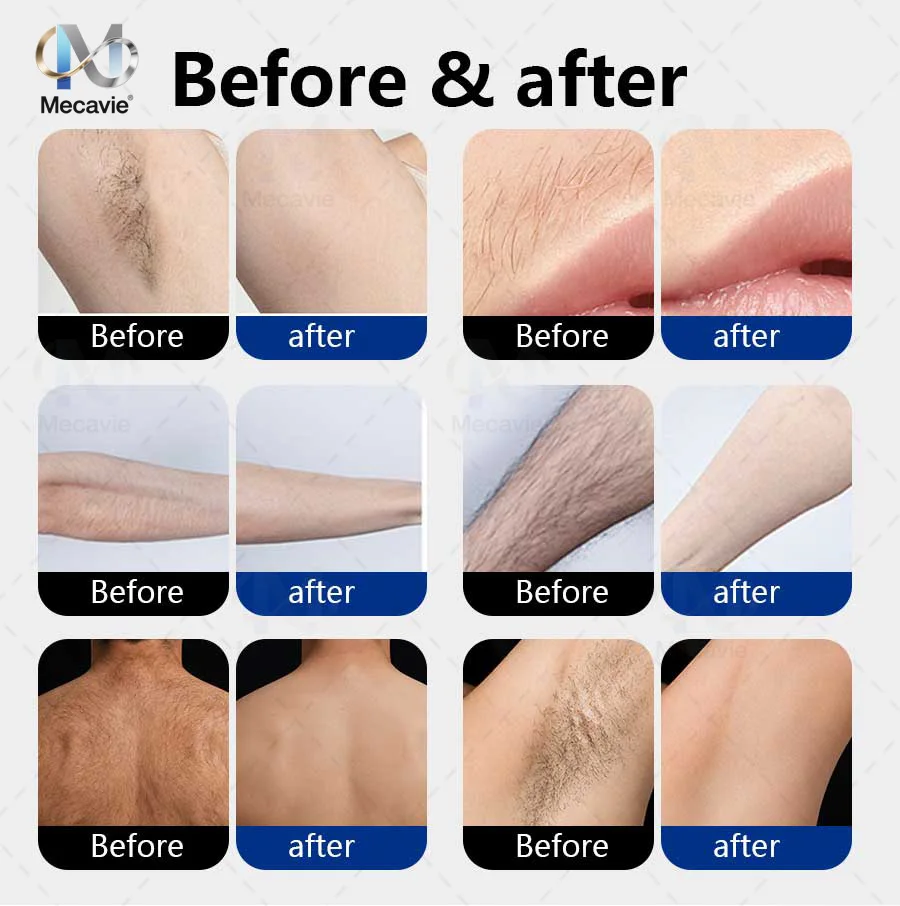 World Premiere 5000W FAC Technology High Power 808 830 8101064 755 940 6 Waves Ice Point Diode Laser Hair Removal Machine Salon