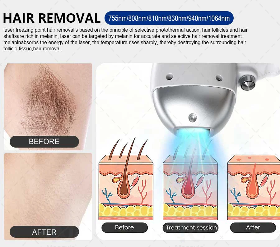World Premiere 5000W FAC Technology High Power 808 830 8101064 755 940 6 Waves Ice Point Diode Laser Hair Removal Machine Salon