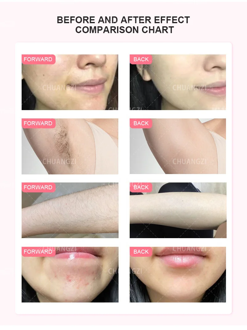OPT 3 Wavelength Portable Hair Removal Laser Machine Professional Equipment For Painless Hair Removal And Skin Rejuvenation HOT