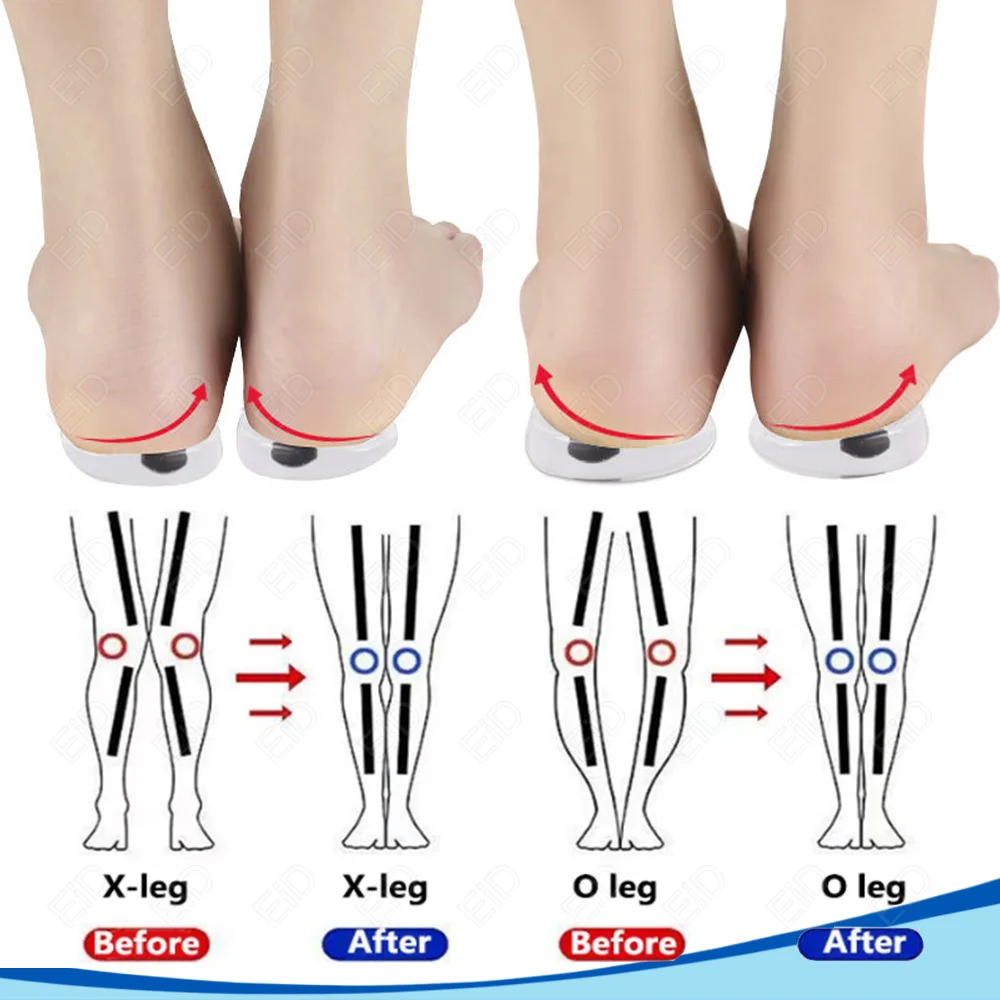 1 Pair Magnets Silicon Orthopedic Insoles Foot Care Tool For Men Women Health Care O/X Type Legs Knee Varus Correction Heel Pads