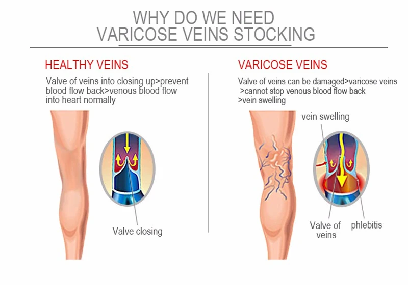 1 Pair Compression Socks Women Support Socks Varicose Veins Exercise Bikes Basketball Pregnancy Edema Medical Nurse Socks S-XXL