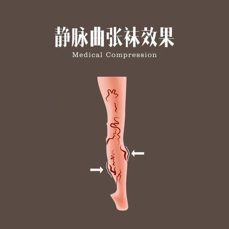 45-80KG Compression Women Tights Varicose Veins 23- 30mmhg Elastic Nursing Over Knee Prevent Slipping S-XXL Stockings