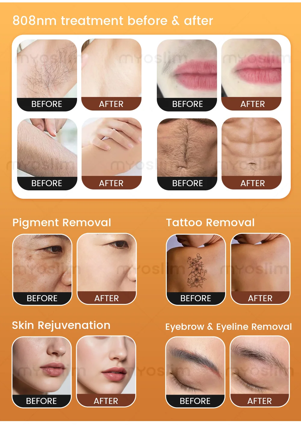 5000W 10Bars IPL Professional 4-in-1 Diode Laser 4 Wavelength Hair Removal Device Pico Laser RF Photorejuvenation Device