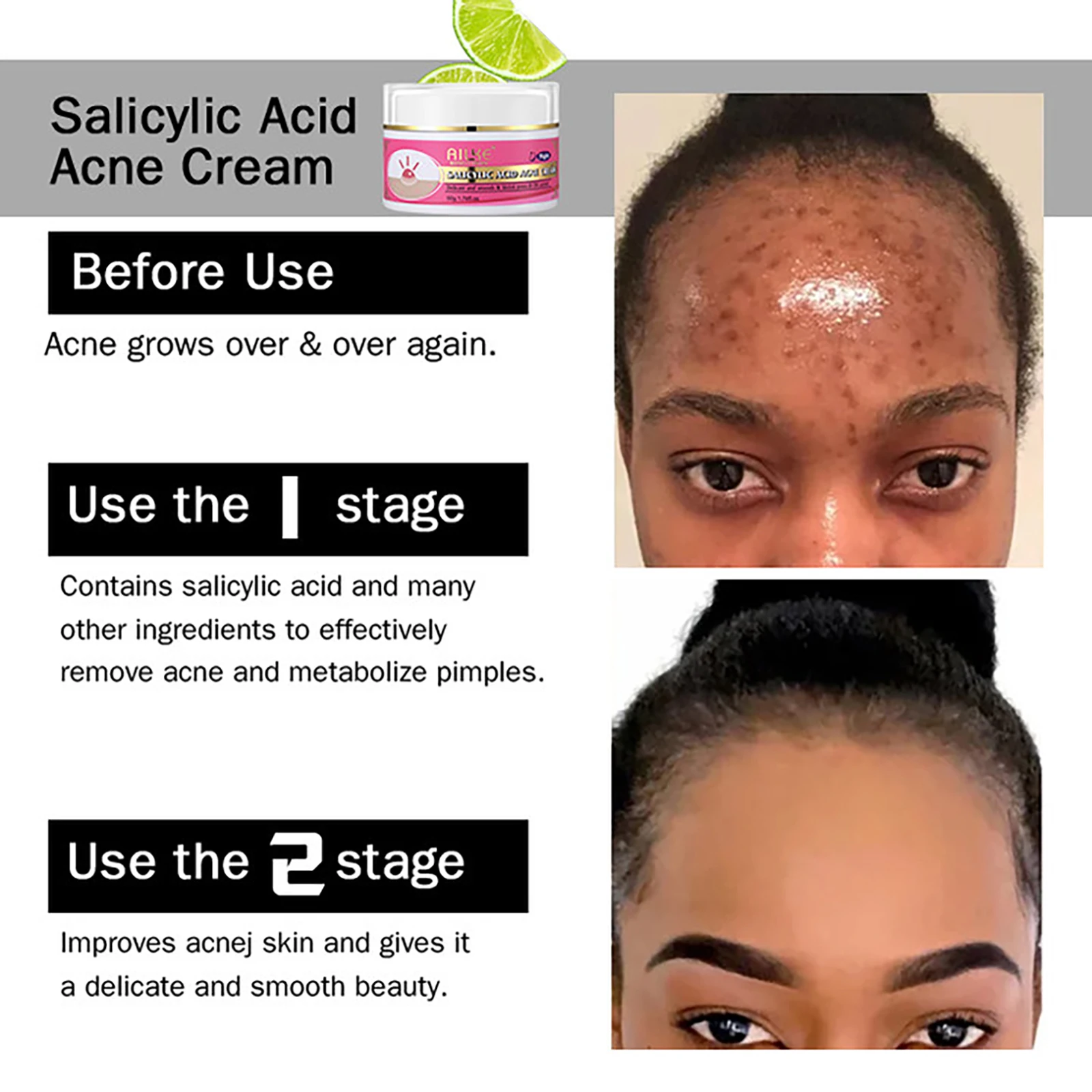 AILKE Anti Acne Face Cream, Brightening, Cleaning Skin, Reduce Blackheads, Dark Spots, For All Skin Tone Facial Cream, 50ml