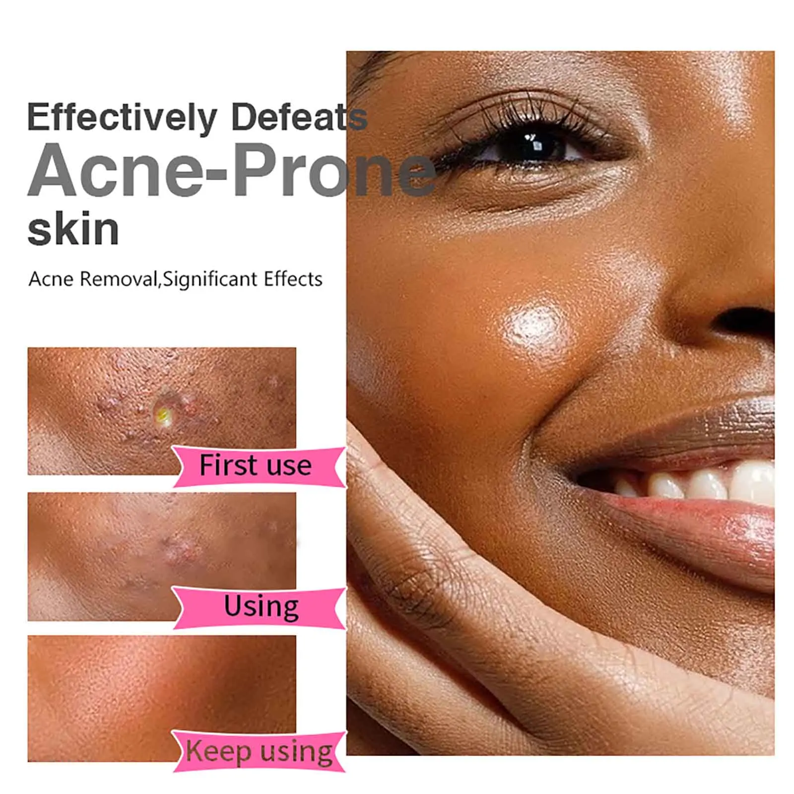 AILKE Anti Acne Face Cream, Brightening, Cleaning Skin, Reduce Blackheads, Dark Spots, For All Skin Tone Facial Cream, 50ml