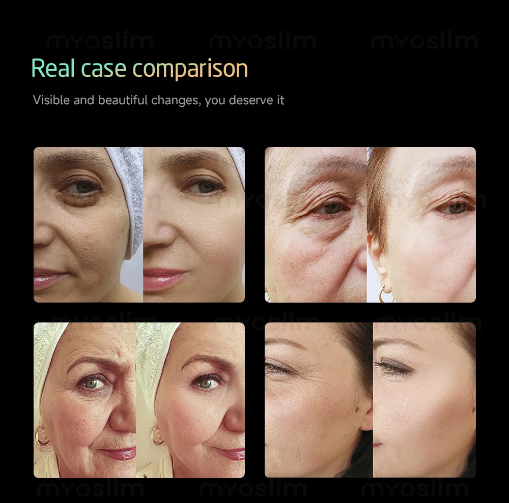 New 25D 360MAX Beauty Machine for Facial Lifting, Skin Tightening and Body Slimming Latest Salon Equipment