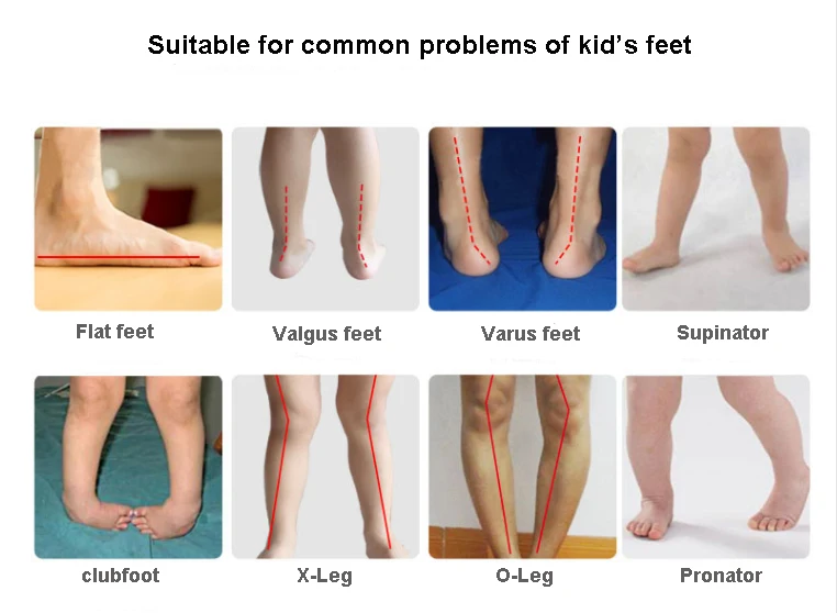 Ortoluckland Girls Casual Shoes Children Mesh Orthopedic Tiptoe Footwear Kids Elastic Band Flatfoot Sneakers